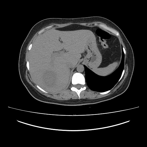 Ascending retrocecal appendicitis with liver abscesses (Radiopaedia 60066-67615 Axial non-contrast 18).jpg