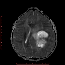 Astroblastoma (Radiopaedia 74287-85162 Axial ADC 38).jpg