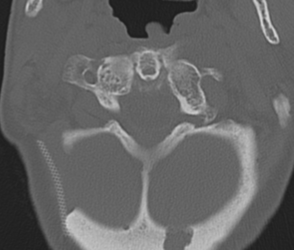 Atlanto-axial subluxation (Radiopaedia 36610-38176 Axial bone window 15).png