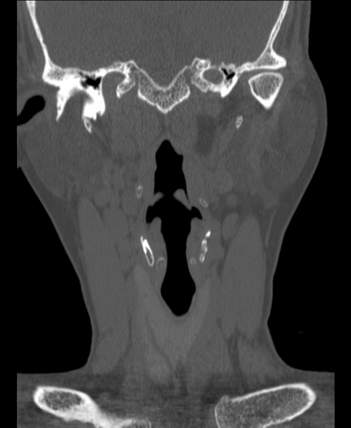 Atlanto-occipital assimilation with basilar invagination (Radiopaedia 70122-80188 Coronal bone window 23).jpg