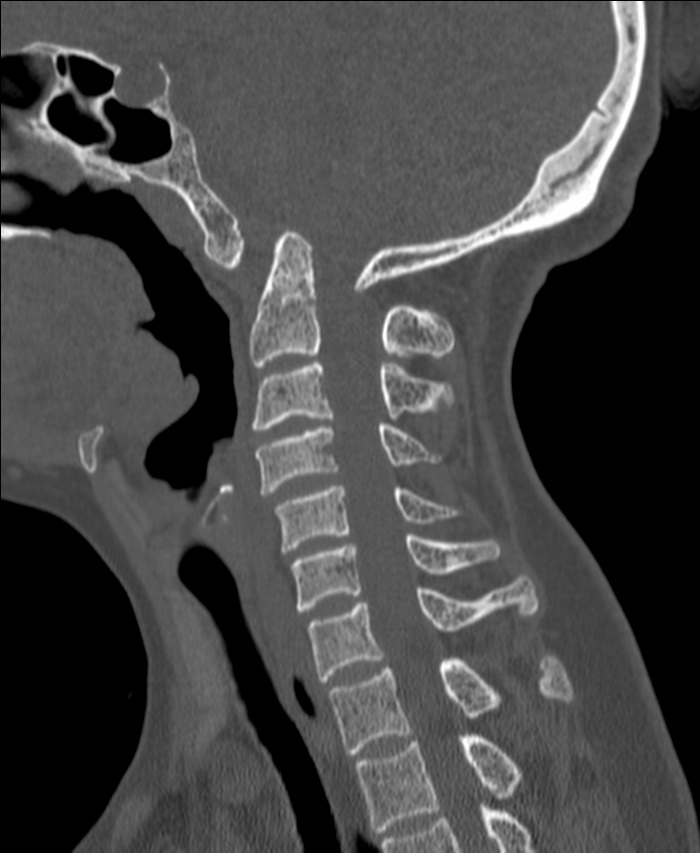 Atlanto-occipital assimilation with basilar invagination (Radiopaedia 70122-80188 Sagittal bone window 58).jpg