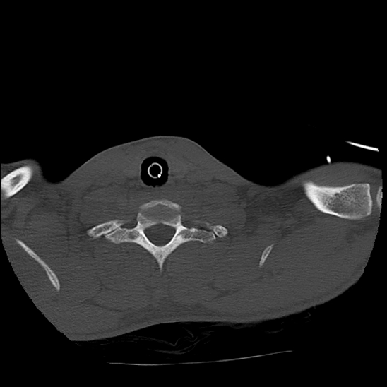 Atlanto-occipital dissociation (Traynelis type 1), C2 teardrop fracture, C6-7 facet joint dislocation (Radiopaedia 87655-104061 Axial bone window 82).jpg