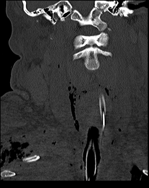 Atlanto-occipital dissociation - Traynelis type 1 (Radiopaedia 87570-103948 Coronal bone window 25).jpg