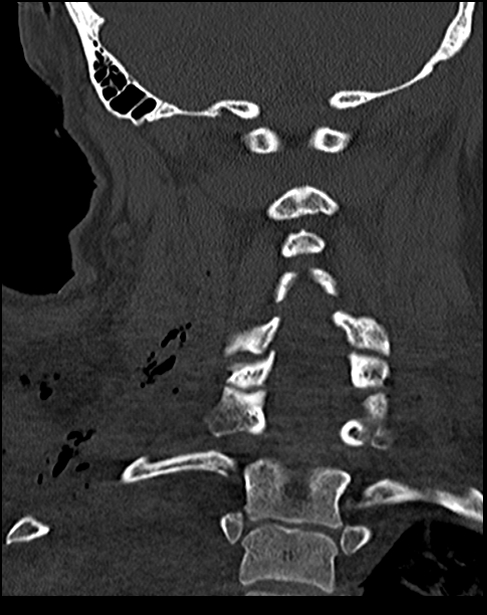Atlanto-occipital dissociation - Traynelis type 1 (Radiopaedia 87570-103948 Coronal bone window 40).jpg