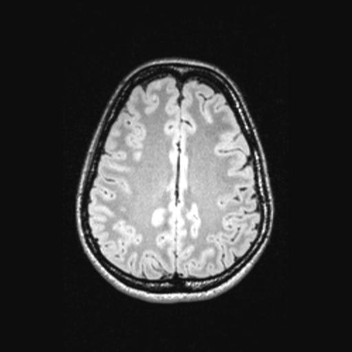 Atretic encephalocoele with inferior vermis hypoplasia (Radiopaedia 30443-31108 Axial 111).jpg