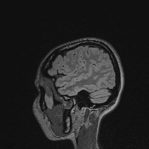 Atretic encephalocoele with inferior vermis hypoplasia (Radiopaedia 30443-31108 Sagittal FLAIR 127).jpg