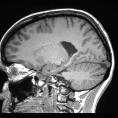 Atretic encephalocoele with inferior vermis hypoplasia (Radiopaedia 30443-31108 Sagittal T1 83).jpg