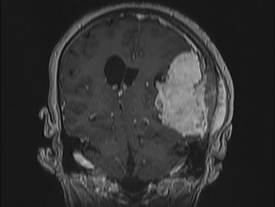 Atypical meningioma (Radiopaedia 62985-71406 Coronal T1 C+ 75).jpg