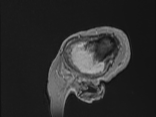 Atypical meningioma (Radiopaedia 62985-71406 Sagittal T1 C+ 101).jpg