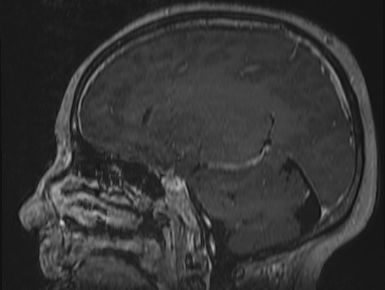 Atypical meningioma (Radiopaedia 62985-71406 Sagittal T1 C+ 53).jpg