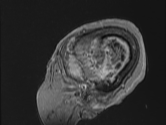 Atypical meningioma (Radiopaedia 62985-71406 Sagittal T1 C+ 94).jpg