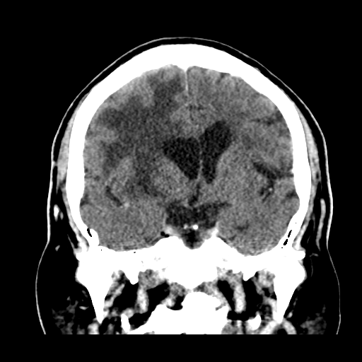 Atypical meningioma (WHO grade II) with brain invasion (Radiopaedia 57767-64728 Coronal C+ 29).png