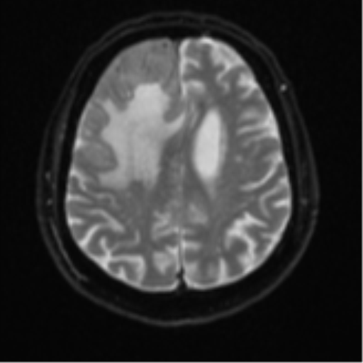 Atypical meningioma (WHO grade II) with brain invasion (Radiopaedia 57767-64729 Axial DWI 21).png