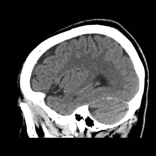 Atypical meningioma (WHO grade II) with osseous invasion (Radiopaedia 53654-59715 G 40).png
