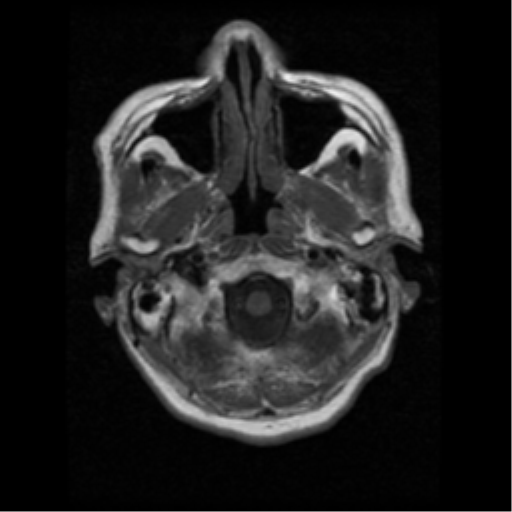 File:Atypical meningioma (WHO grade II) with osseous invasion (Radiopaedia 53654-59716 Axial T1 2).png