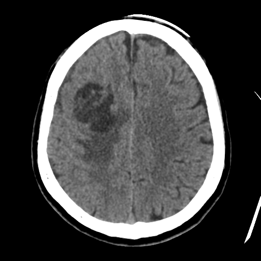Atypical meningioma with skull invasion (Radiopaedia 34357-35649 Axial non-contrast 37).png