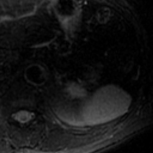 File:Atypical renal cyst on MRI (Radiopaedia 17349-17046 Axial T2 fat sat 2).jpg