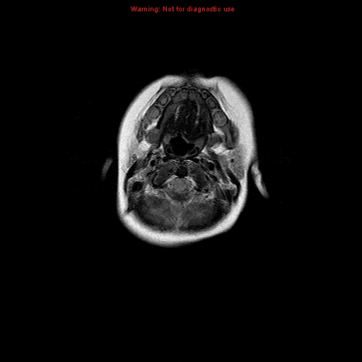 File:Atypical teratoid rhabdoid tumor (Radiopaedia 10712-11183 Axial FLAIR 18).jpg