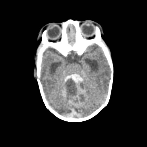 File:Atypical teratoid rhabdoid tumor (prenatal US and neonatal MRI) (Radiopaedia 59091-66387 Axial non-contrast 15).jpg