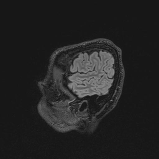 Autoimmune limbic encephalitis (Radiopaedia 30363-31005 Sagittal FLAIR 25).jpg