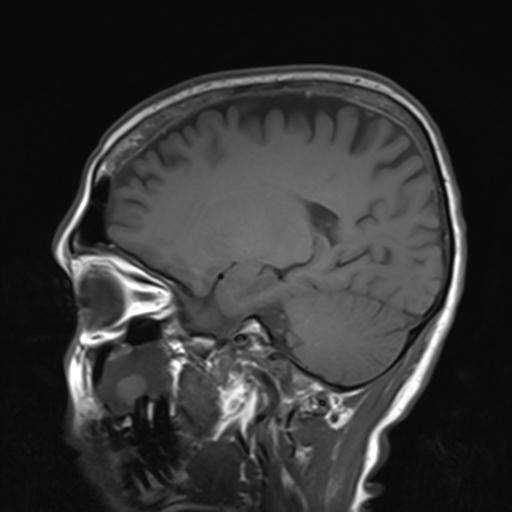 File:Autoimmune limbic encephalitis (Radiopaedia 30363-31005 Sagittal T1 17).jpg