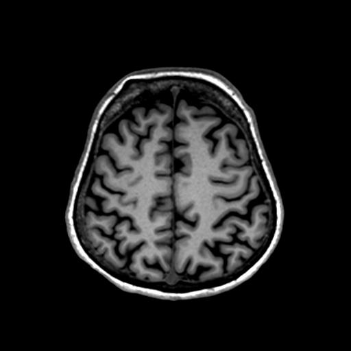 File:Autoimmune limbic encephalitis (Radiopaedia 30363-31005 T1 Axial 1mm 116).jpg