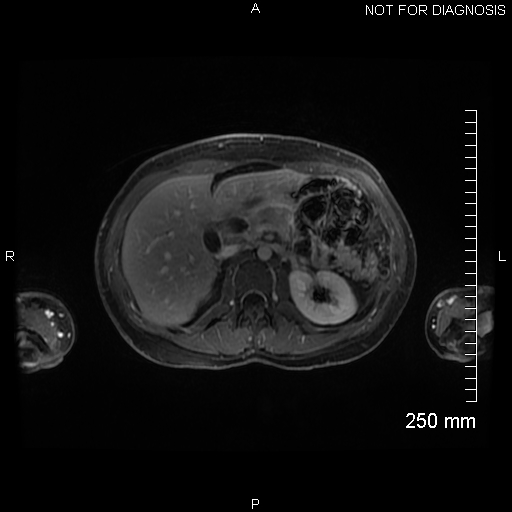 Autoimmune pancreatitis (Radiopaedia 88443-105101 A 61).jpg