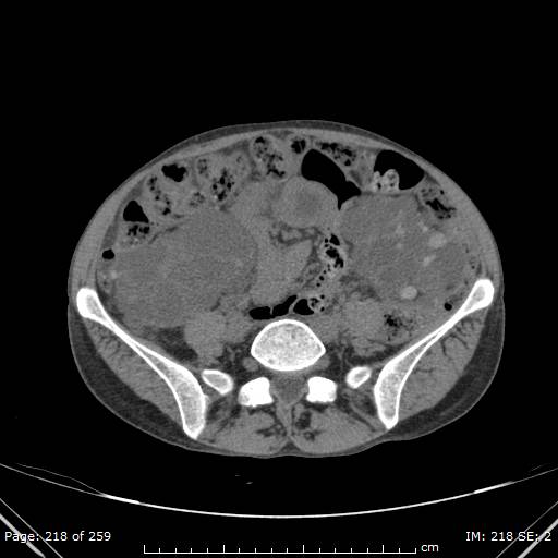 File:Autosomal dominant polycystic kidney disease (Radiopaedia 44122-47684 Axial 62).jpg