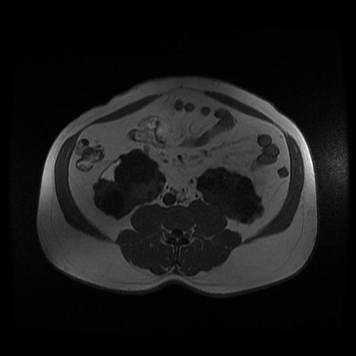 Autosomal dominant polycystic kidney disease (Radiopaedia 50259-55611 Axial 2D Dual Echo 62).jpg