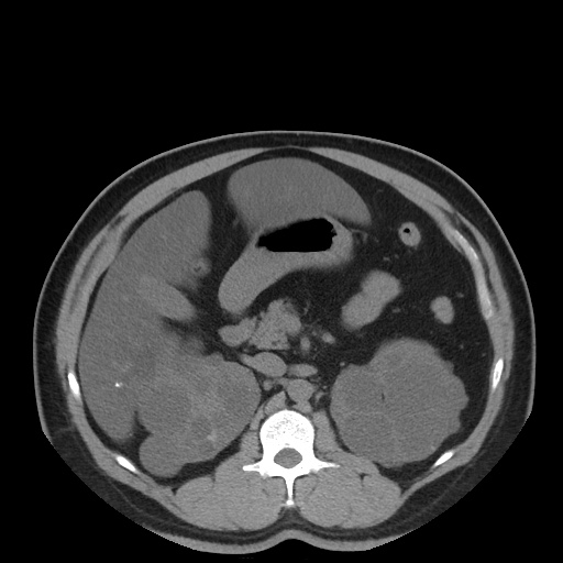 Autosomal dominant polycystic kidney disease (Radiopaedia 50259-55612 Axial non-contrast 33).jpg