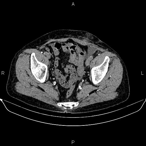 Autosomal dominant polycystic kidney disease (Radiopaedia 87830-104287 Axial non-contrast 49).jpg