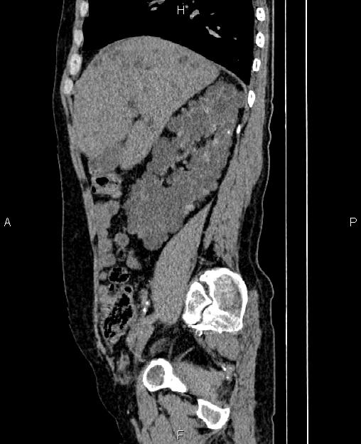 Autosomal dominant polycystic kidney disease (Radiopaedia 87830-104287 C 27).jpg