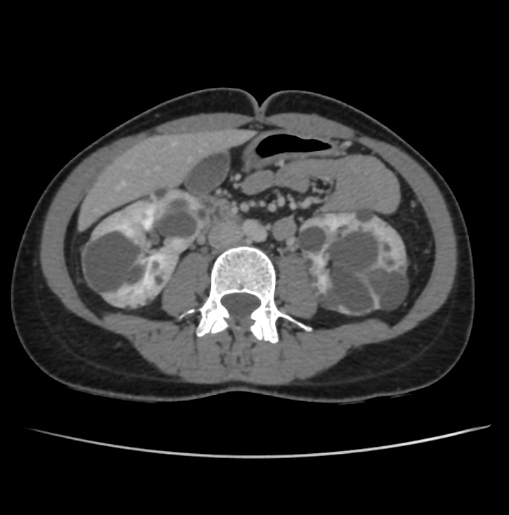 Autosomal dominant polycystic kidney disease - early onset (Radiopaedia 40734-43387 A 44).jpg