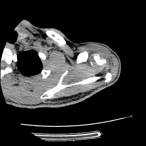 Avascular necrosis after fracture dislocations of the proximal humerus (Radiopaedia 88078-104655 D 34).jpg