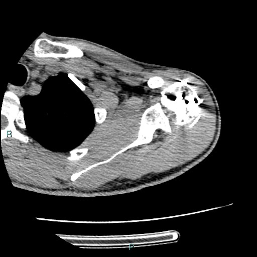 Avascular necrosis after fracture dislocations of the proximal humerus (Radiopaedia 88078-104655 D 43).jpg