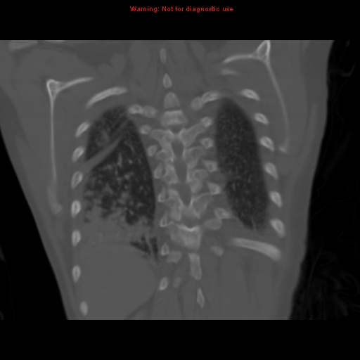 File:Avascular necrosis in sickle cell disease (Radiopaedia 17448-17152 Coronal bone window 105).jpg