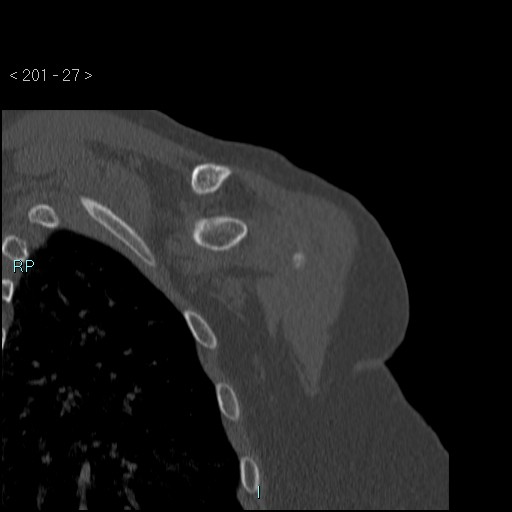 Avascular necrosis of the shoulder - Cruess stage I (Radiopaedia 77674-89887 Coronal bone window 26).jpg