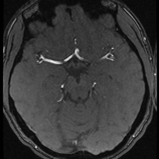 Azygos anterior cerebral artery (Radiopaedia 17059-16756 Axial MRA 39).jpg