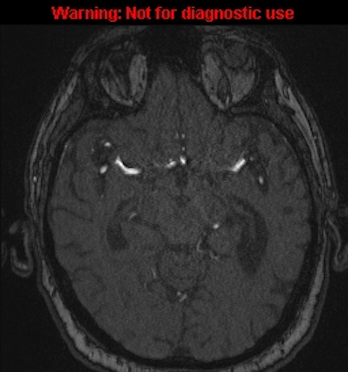 Azygos anterior cerebral artery (Radiopaedia 59325-66677 Axial MRA 71).jpg