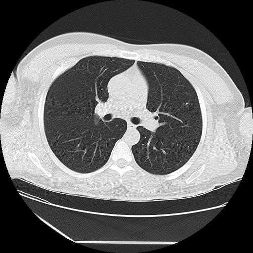 Azygos fissure (Radiopaedia 88181-104784 Axial lung window 21).jpg