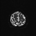 File:Balo concentric sclerosis (Radiopaedia 50458-55940 Axial DWI 3).jpg
