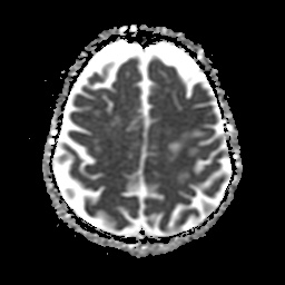 File:Balo concentric sclerosis (Radiopaedia 53875-59982 Axial ADC 19).jpg