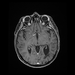 Balo concentric sclerosis (Radiopaedia 53875-59982 Axial LAVA C+ 122).jpg
