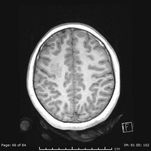 Balo concentric sclerosis (Radiopaedia 61637-69636 Axial T1 66).jpg