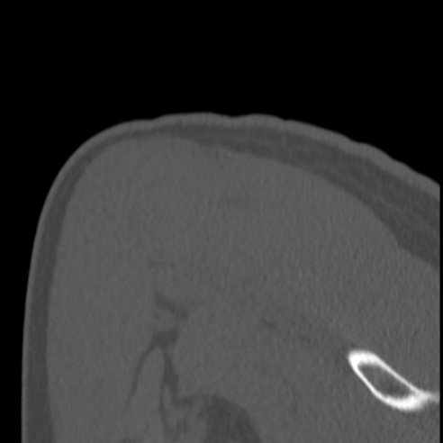 Bankart lesion (Radiopaedia 57256-64185 Coronal bone window 41).jpg