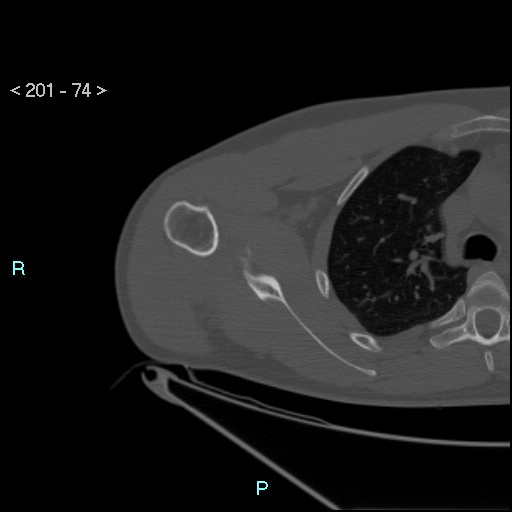 Bankart lesion with glenoid bone defect - assessment TC with PICO method (Radiopaedia 42855-93901 Axial bone window 73).jpg