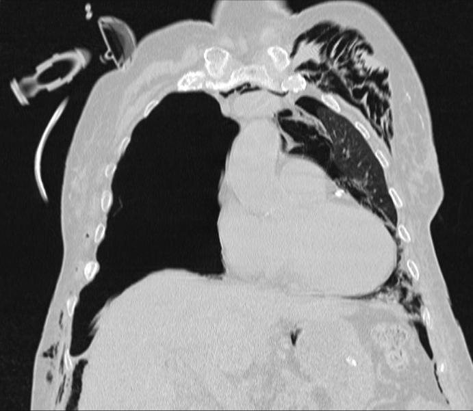 Barotrauma due to mechanical ventilation (Radiopaedia 28079-28336 Coronal lung window 37).jpg