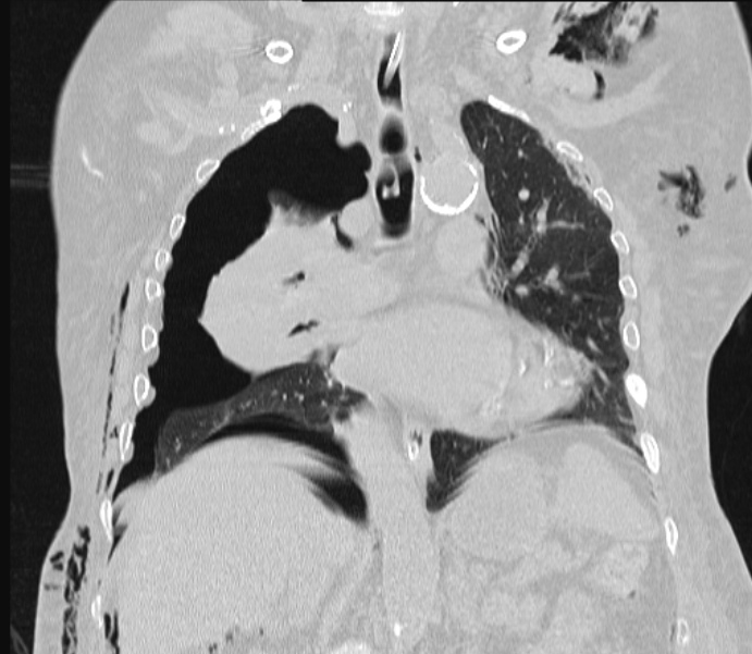 Barotrauma due to mechanical ventilation (Radiopaedia 28079-28336 Coronal lung window 53).jpg