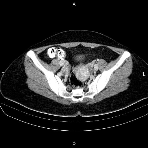 File:Bartholin gland cyst (Radiopaedia 62635-70930 Axial Post contrast 33).jpg