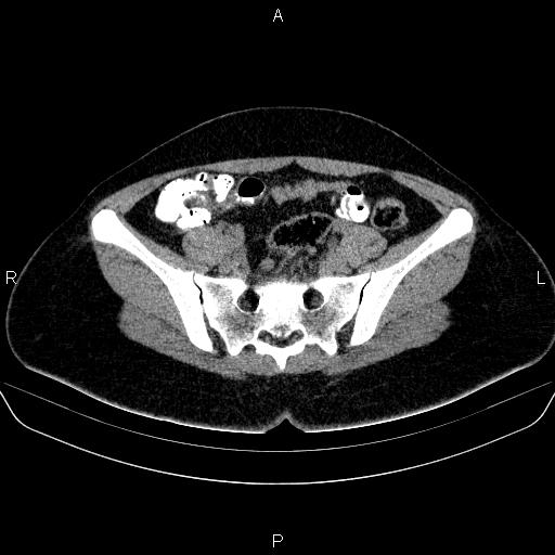 Bartholin gland cyst (Radiopaedia 62635-70930 Axial non-contrast 26).jpg